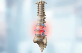 Bel ve Boyun Fıtığında "Nokta Atışı Tedavisi" (Epidural Enjeksiyon) Ne Kadar Sürede Etki Eder? İşlem Ağrılı mıdır?