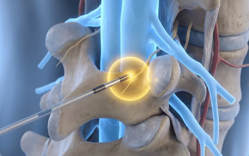 Radyofrekans Ablasyon (Sinir Yakma) Tedavisi Nedir ve Nasıl Çalışır?